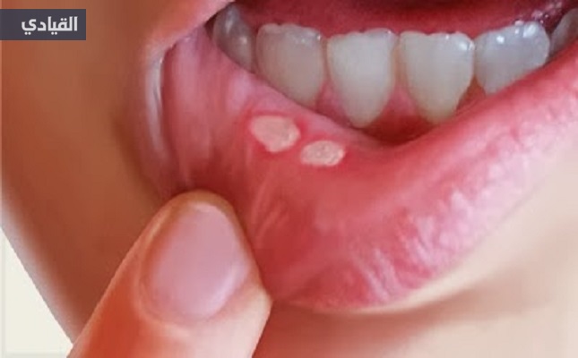 تعرف على أسباب ظهور فطريات الفم في الشتاء وكيفية التغلب عليها